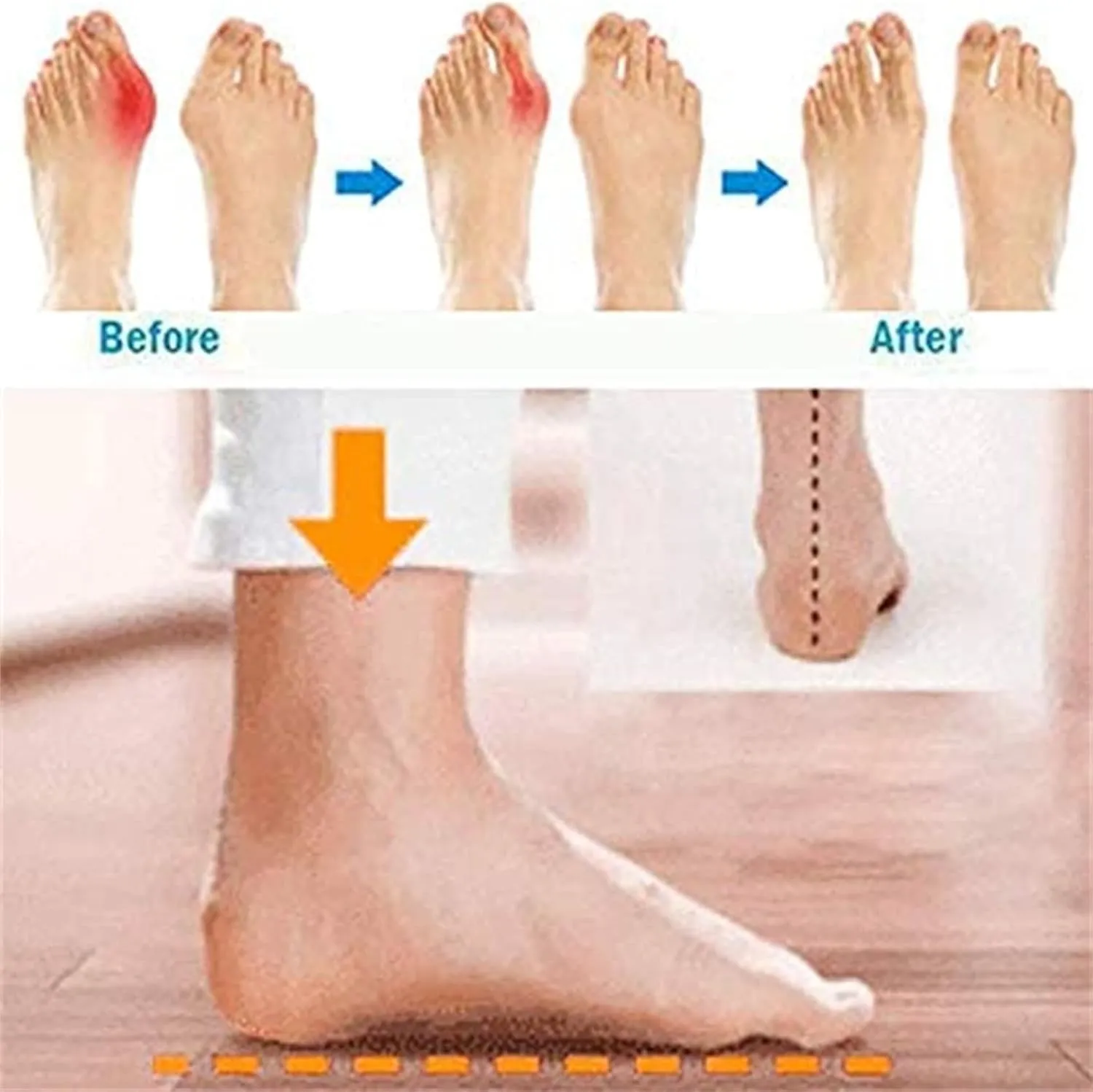 FFMA Summer Bunion Orthopedic Sandals for Womens Big Toe Correction Sandals Low Wedge Slides Backless Sandals Outdor Indoor Comfortable Shoes
