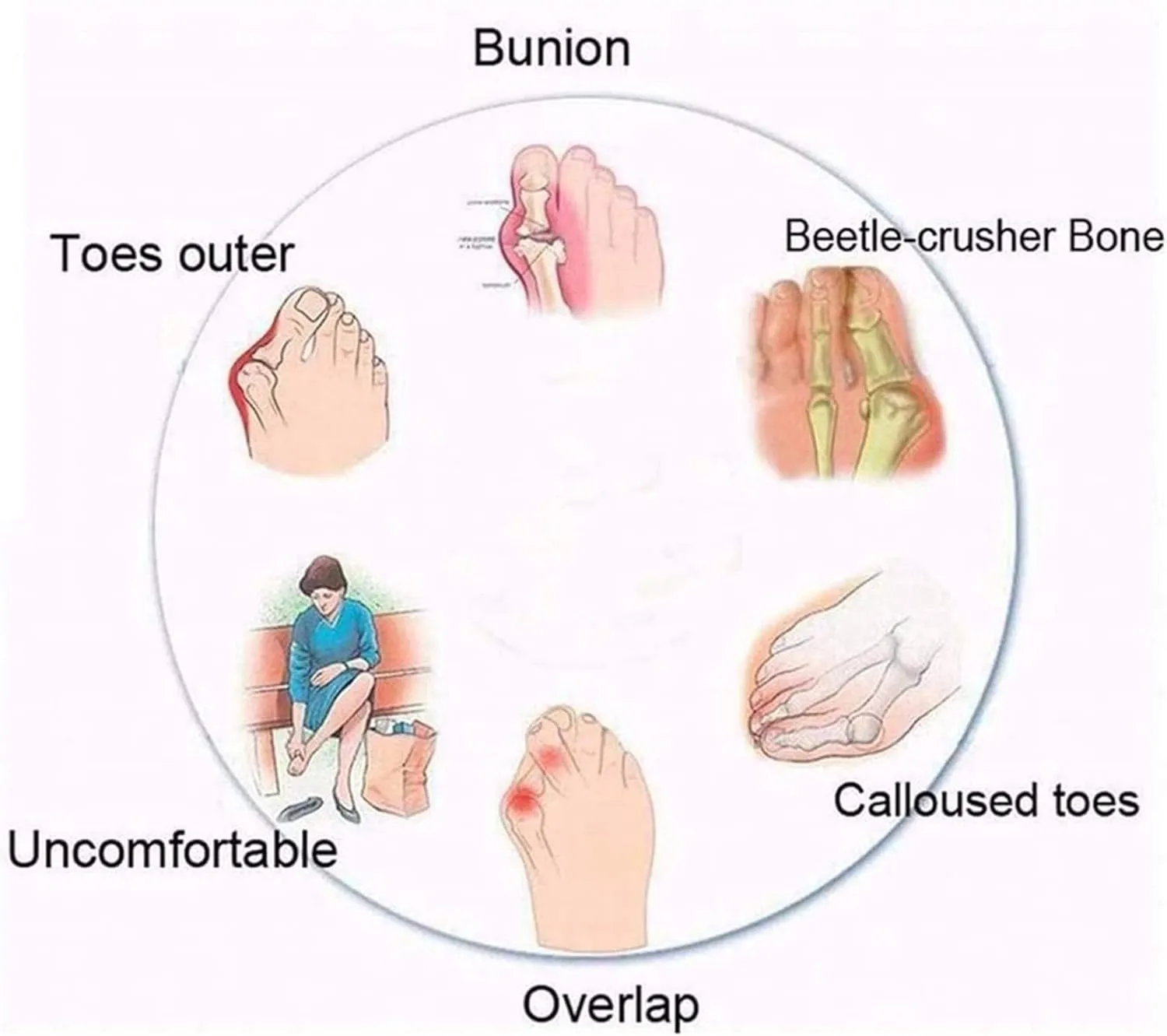 FFMA Summer Bunion Orthopedic Sandals for Womens Big Toe Correction Sandals Low Wedge Slides Backless Sandals Outdor Indoor Comfortable Shoes